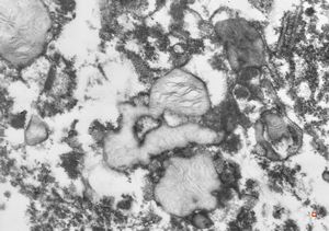 M,27y. | intracellular cholestasis - intoxication M,27y. | intracellular cholestasis - intoxication